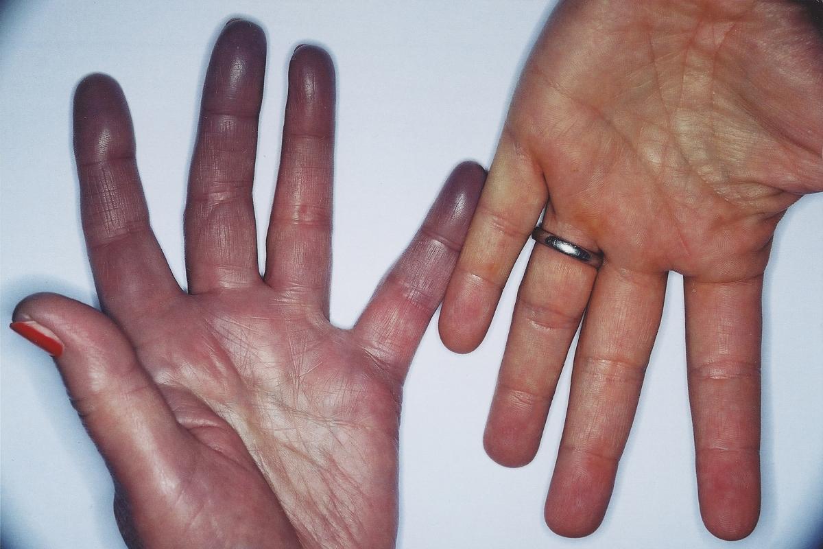 Cyanosis example with hands