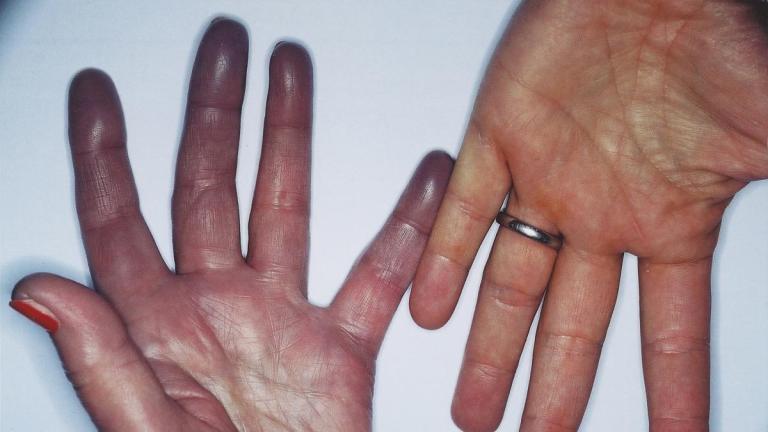 Cyanosis example
